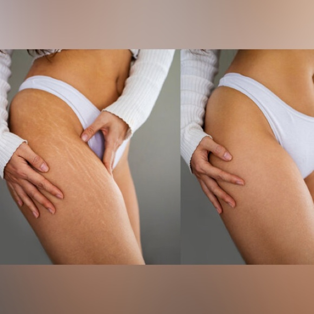 Organic Cellulite Scar Spider Veins Stretch Mark Cream